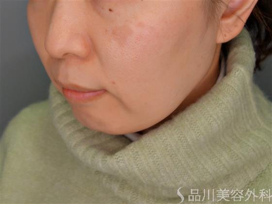 症例NO.55049のBEFORE写真