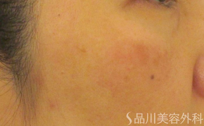 症例NO.65272のAFTER写真
