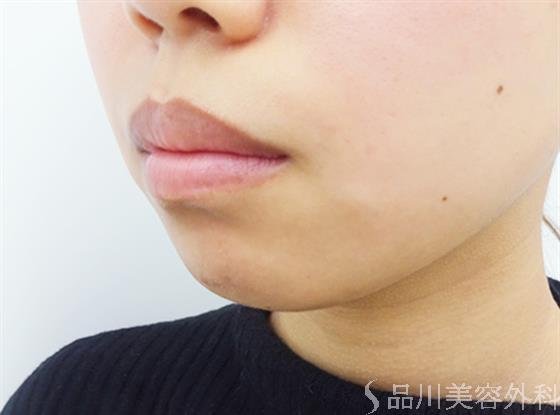 症例NO.40864のBEFORE写真