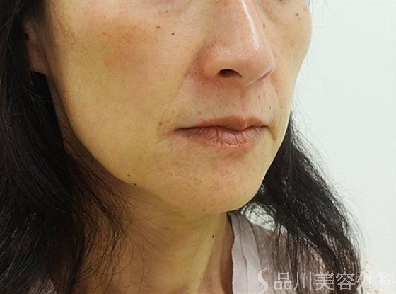 症例NO.30517のBEFORE写真