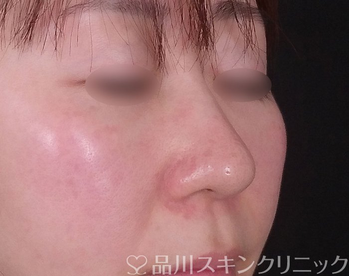 症例NO.69219のBEFORE写真