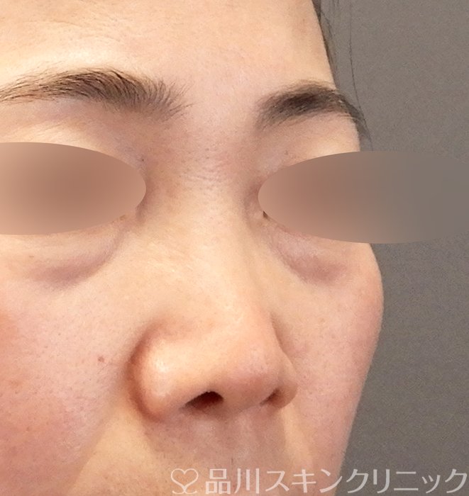 症例NO.63408のBEFORE写真