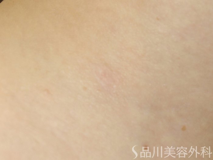 症例NO.68609のAFTER写真