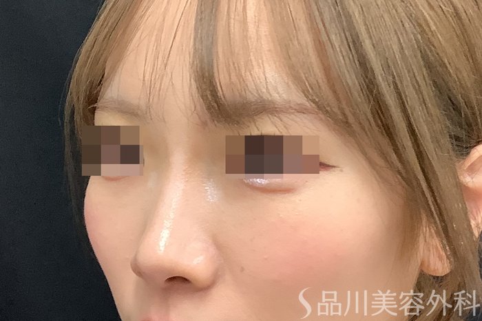 症例NO.71637のBEFORE写真