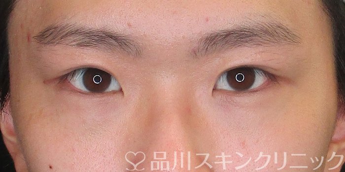症例NO.73088のBEFORE写真