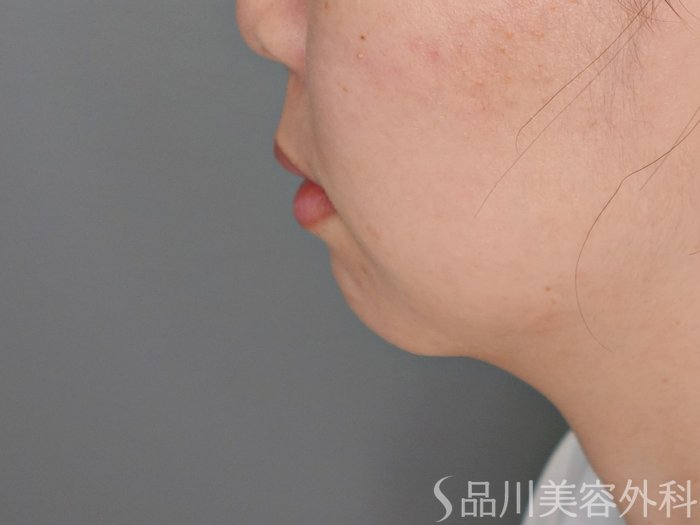 症例NO.70968のBEFORE写真