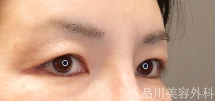 症例NO.67762のBEFORE写真