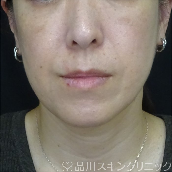 症例NO.71988のBEFORE写真