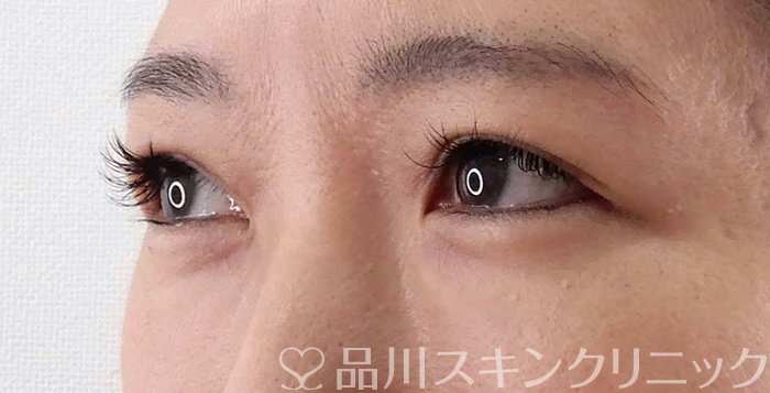症例NO.62183のBEFORE写真