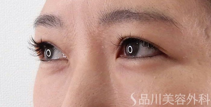 症例NO.62183のBEFORE写真