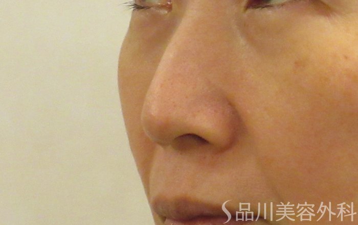 症例NO.69353のBEFORE写真