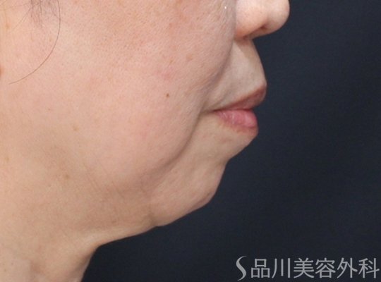 症例NO.74635のBEFORE写真