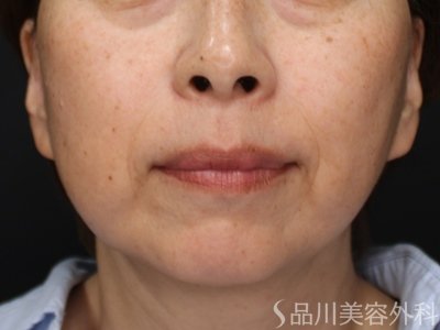症例NO.74865のBEFORE写真