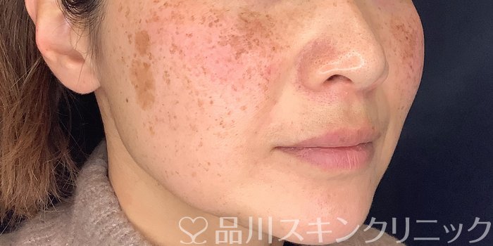 症例NO.70247のBEFORE写真