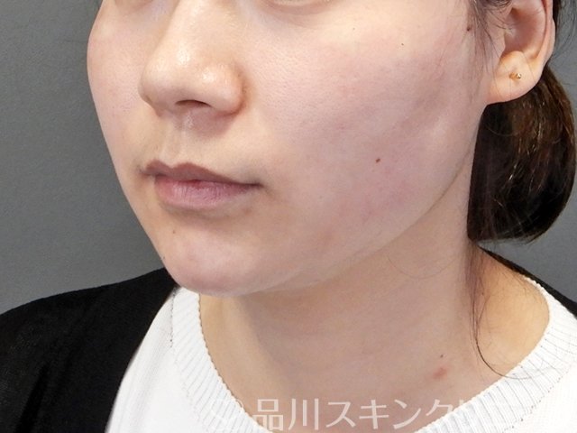 症例NO.64503のAFTER写真