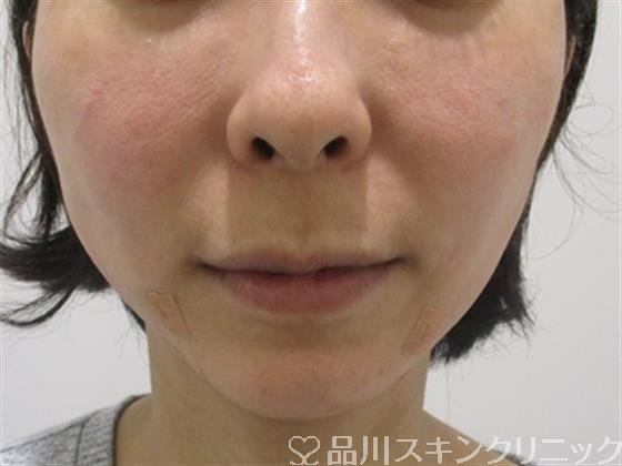 症例NO.34169のAFTER写真