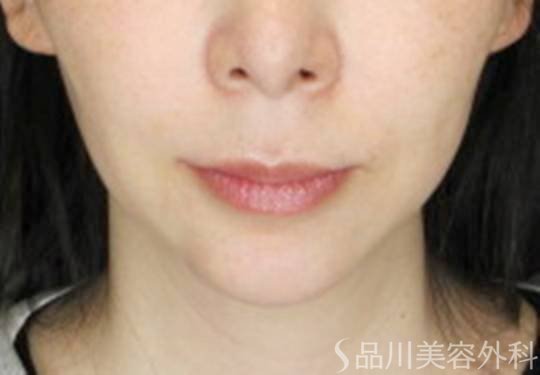 症例NO.72468のBEFORE写真