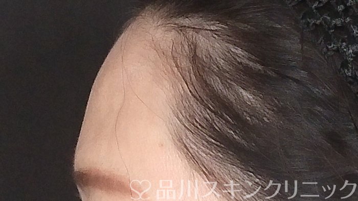 症例NO.71743のBEFORE写真