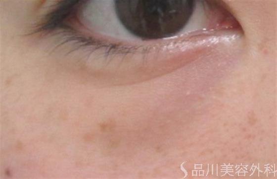 症例NO.21095のBEFORE写真