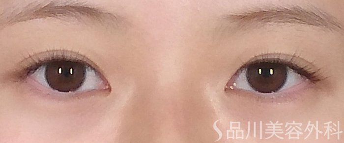 症例NO.69236のBEFORE写真