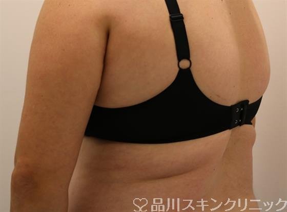 症例NO.47406のBEFORE写真