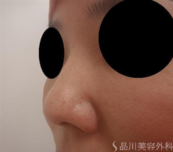症例NO.9929のBEFORE写真