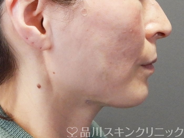 症例NO.72979のAFTER写真