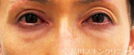 症例NO.44280のBEFORE写真