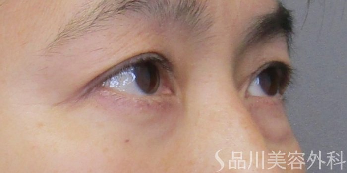 症例NO.75136のAFTER写真