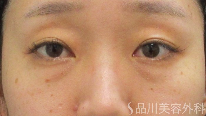 症例NO.72183のBEFORE写真