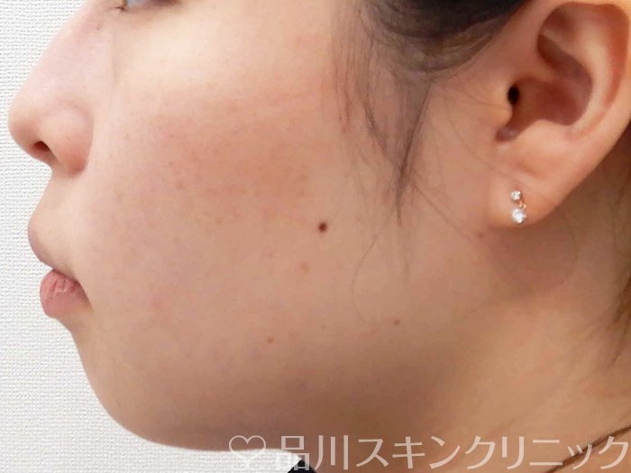 症例NO.63697のBEFORE写真