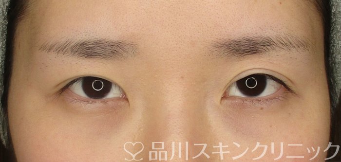 症例NO.69894のBEFORE写真