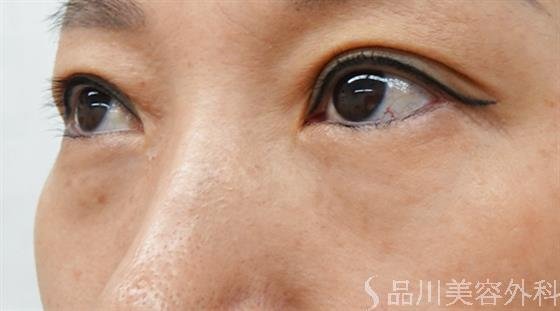 症例NO.46605のBEFORE写真