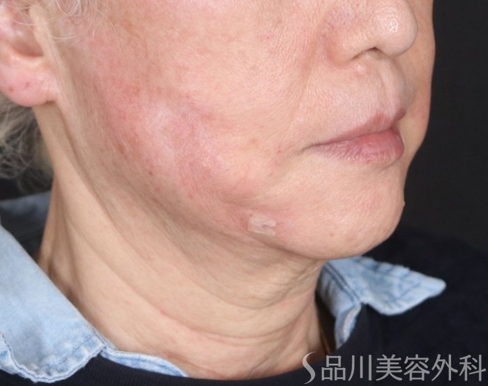 症例NO.73729のAFTER写真