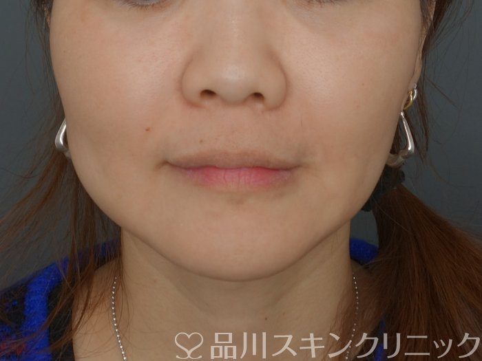 症例NO.74063のBEFORE写真