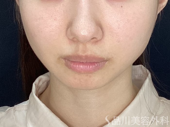 症例NO.71630のBEFORE写真