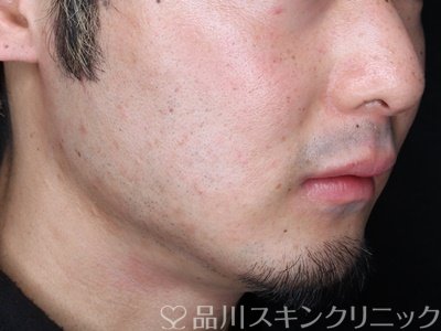 症例NO.72833のAFTER写真