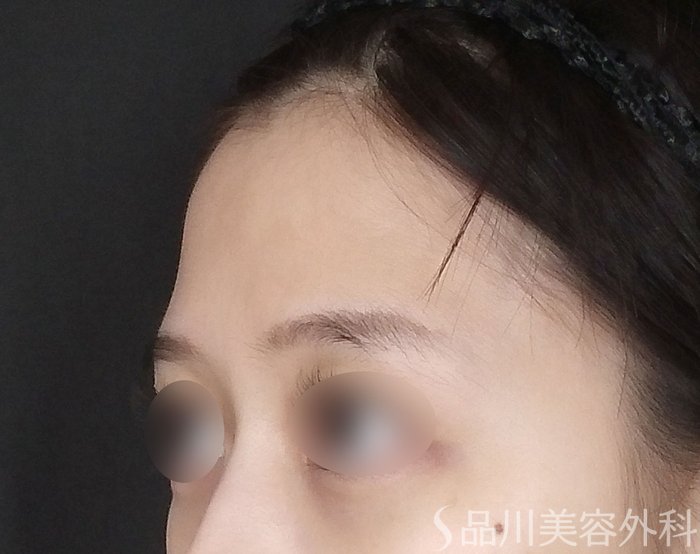 症例NO.67822のBEFORE写真