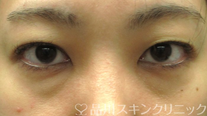 症例NO.70508のBEFORE写真