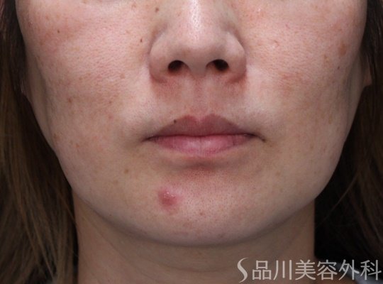 症例NO.69921のBEFORE写真