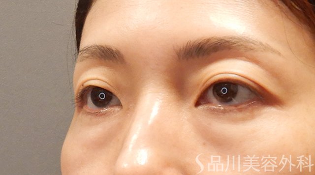 症例NO.73999のBEFORE写真