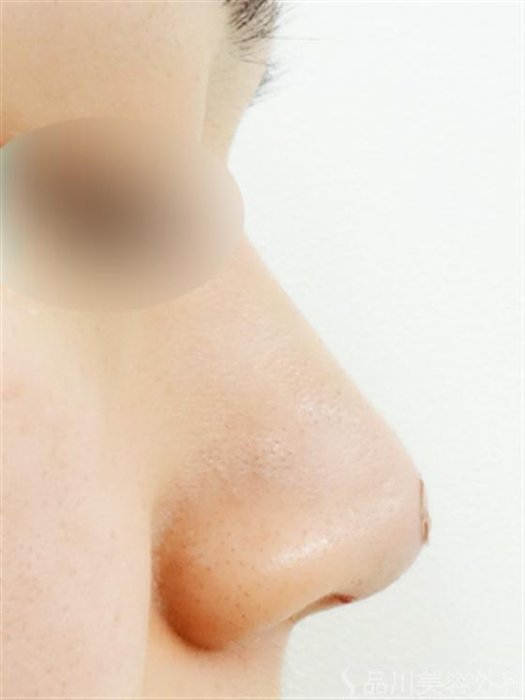 症例NO.16569のAFTER写真