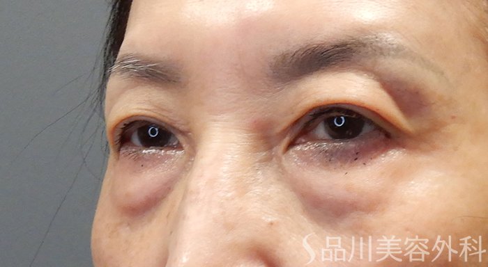 症例NO.69897のBEFORE写真