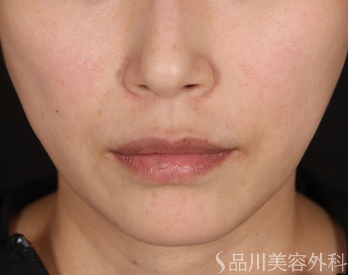 症例NO.74072のBEFORE写真