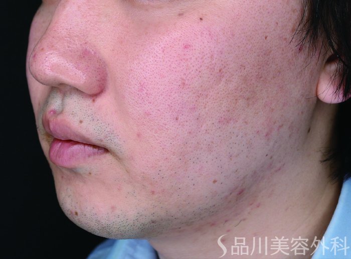 症例NO.71300のBEFORE写真