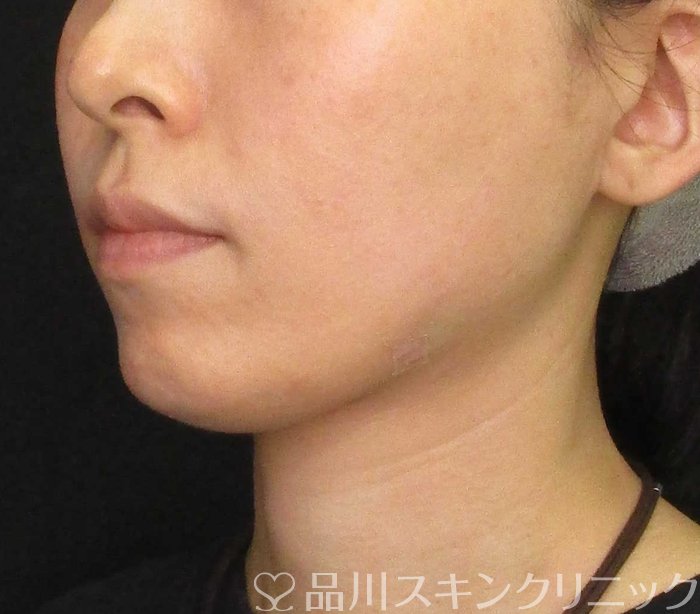 症例NO.70068のAFTER写真