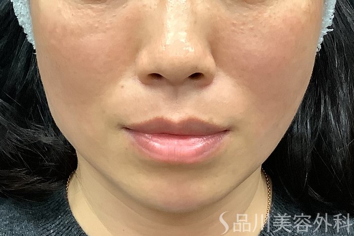 症例NO.73314のAFTER写真