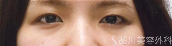 症例NO.21797のBEFORE写真
