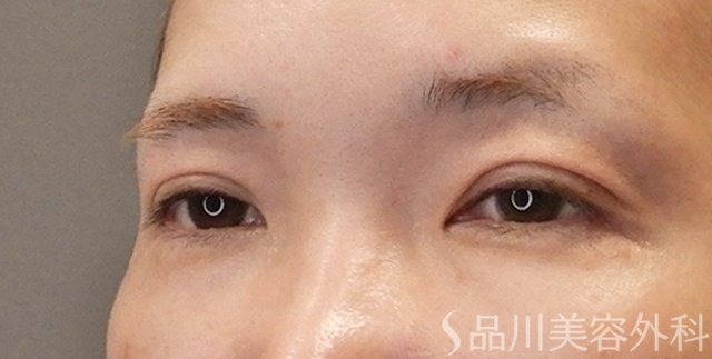 症例NO.75109のAFTER写真