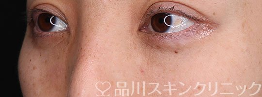 症例NO.74835のAFTER写真